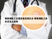 银屑病脸上总是反复出现红点 银屑病脸上有白点怎么回事