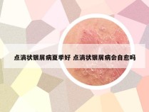 点滴状银屑病夏季好 点滴状银屑病会自愈吗