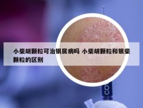 小柴胡颗粒可治银屑病吗 小柴胡颗粒和银柴颗粒的区别