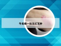 牛皮癣一扣又红又肿