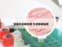 张贴牛皮癣处理 牛皮肤癣贴吧