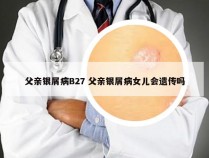 父亲银屑病B27 父亲银屑病女儿会遗传吗