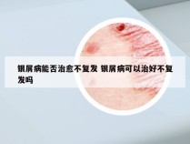 银屑病能否治愈不复发 银屑病可以治好不复发吗