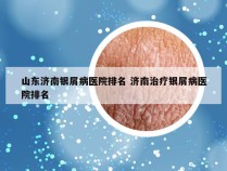 山东济南银屑病医院排名 济南治疗银屑病医院排名