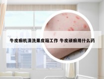 牛皮癣机清洗果皮箱工作 牛皮顽癣用什么药