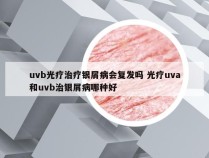 uvb光疗治疗银屑病会复发吗 光疗uva和uvb治银屑病哪种好