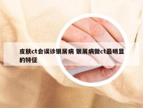 皮肤ct会误诊银屑病 银屑病做ct最明显的特征