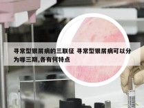 寻常型银屑病的三联征 寻常型银屑病可以分为哪三期,各有何特点