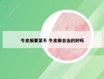 牛皮癣要紧不 牛皮癣会治的好吗