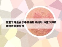 体重下降是由于牛皮癣影响的吗 体重下降皮肤松弛需要警惕