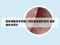银屑病服用甘草酸二铵胶囊有副作用吗 银屑病吃甘草片