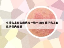 小孩头上有头癣头皮一块一块的 孩子头上有几块像头皮癣