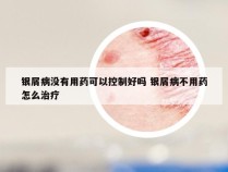 银屑病没有用药可以控制好吗 银屑病不用药怎么治疗