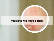 牛皮癣艾灸 牛皮肤癣艾灸有用吗