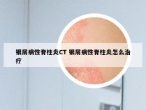 银屑病性脊柱炎CT 银屑病性脊柱炎怎么治疗