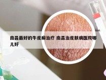 南昌最好的牛皮癣治疗 南昌治皮肤病医院哪儿好