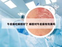 牛皮癣吃蜂胶好了 蜂胶对牛皮癣有效果吗
