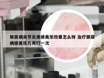 银屑病关节炎用修美乐效果怎么样 治疗银屑病修美乐几周打一次