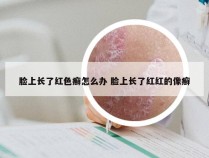 脸上长了红色癣怎么办 脸上长了红红的像癣