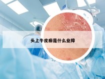 头上牛皮癣是什么业障