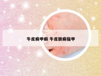 牛皮癣甲癣 牛皮肤癣指甲