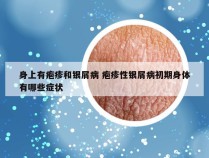 身上有疱疹和银屑病 疱疹性银屑病初期身体有哪些症状