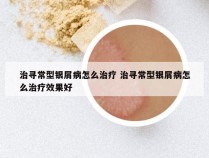 治寻常型银屑病怎么治疗 治寻常型银屑病怎么治疗效果好