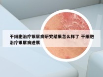 干细胞治疗银屑病研究结果怎么样了 干细胞治疗银屑病进展