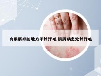 有银屑病的地方不长汗毛 银屑病患处长汗毛