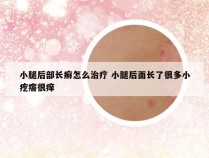 小腿后部长癣怎么治疗 小腿后面长了很多小疙瘩很痒