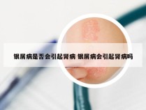 银屑病是否会引起肾病 银屑病会引起肾病吗