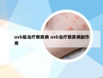 uvb能治疗银屑病 uvb治疗银屑病副作用