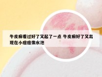 牛皮癣看过好了又起了一点 牛皮癣好了又出现在小痘痘像水泡