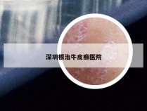 深圳根治牛皮癣医院