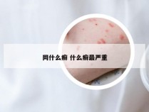 同什么癣 什么癣最严重