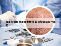 红皮型银屑病用凡士林吗 红皮型银屑吃什么药