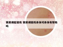 银屑病能锻炼 银屑病锻炼身体对身体有帮助吗