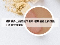 银屑病身上的斑能下去吗 银屑病身上的斑能下去吗会传染吗