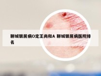 聊城银屑病O定王尚和A 聊城银屑病医院排名