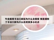 牛皮癣用卡泊三醇后为什么会瘙痒 银屑病擦了卡泊三醇为什么出现很多小红点