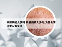 银屑病的人多吗 银屑病的人多吗,为什么生活中没有见过