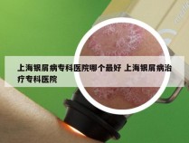 上海银屑病专科医院哪个最好 上海银屑病治疗专科医院