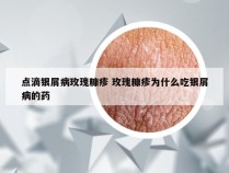 点滴银屑病玫瑰糠疹 玫瑰糠疹为什么吃银屑病的药