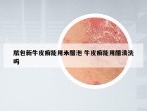 脓包新牛皮癣能用米醋泡 牛皮癣能用醋清洗吗