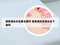 银屑病会长在眉毛里吗 银屑病会长到女生下面吗