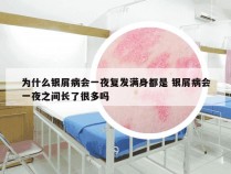 为什么银屑病会一夜复发满身都是 银屑病会一夜之间长了很多吗