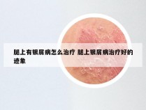 腿上有银屑病怎么治疗 腿上银屑病治疗好的迹象