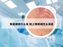 银屑病用什么洗 脸上银屑病怎么消退