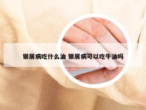 银屑病吃什么油 银屑病可以吃牛油吗