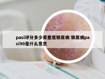pasi评分多少算重度银屑病 银屑病pasi90是什么意思